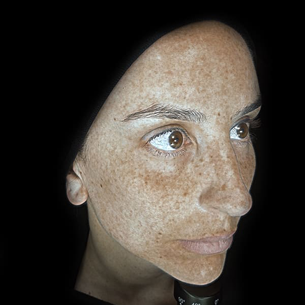 Gallery Side Pigmentation-02